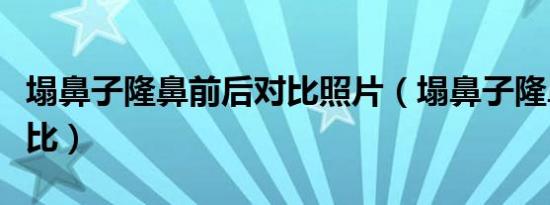 塌鼻子隆鼻前后对比照片（塌鼻子隆鼻前后对比）